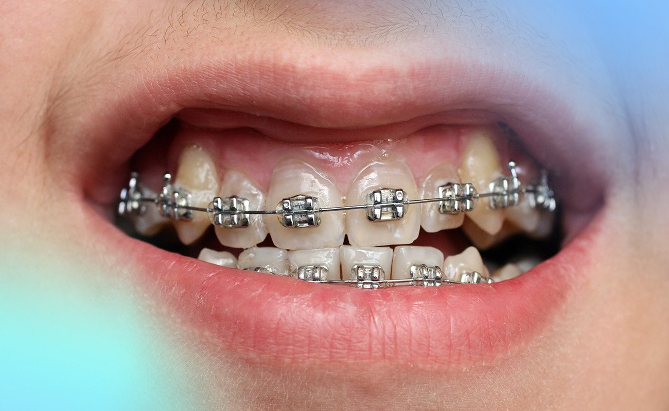 Alternative To Braces