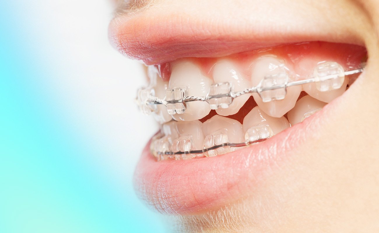 Clear Braces on The Top and Bottom Teeth