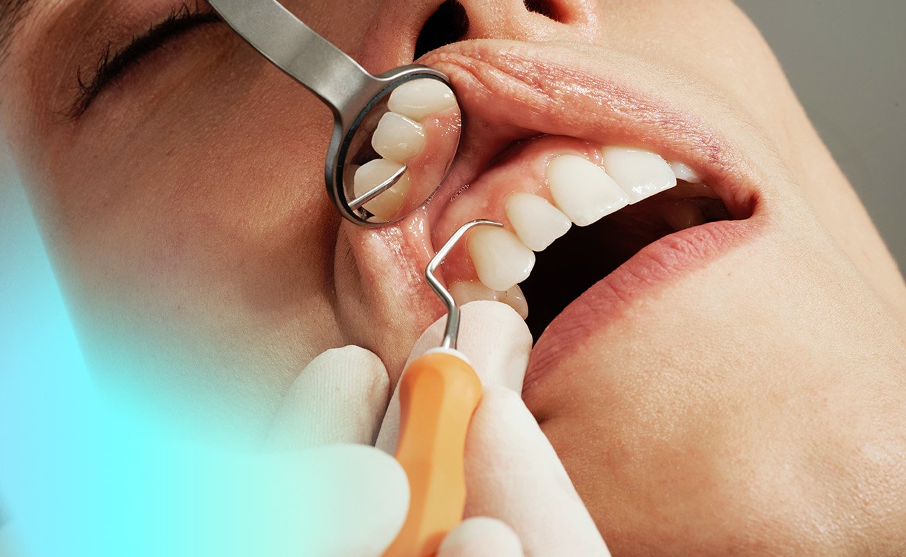 How to Fix a Snaggletooth