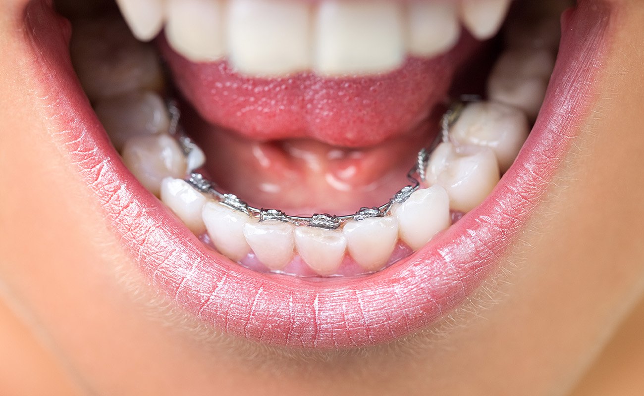 Incognito braces vs Invisalign