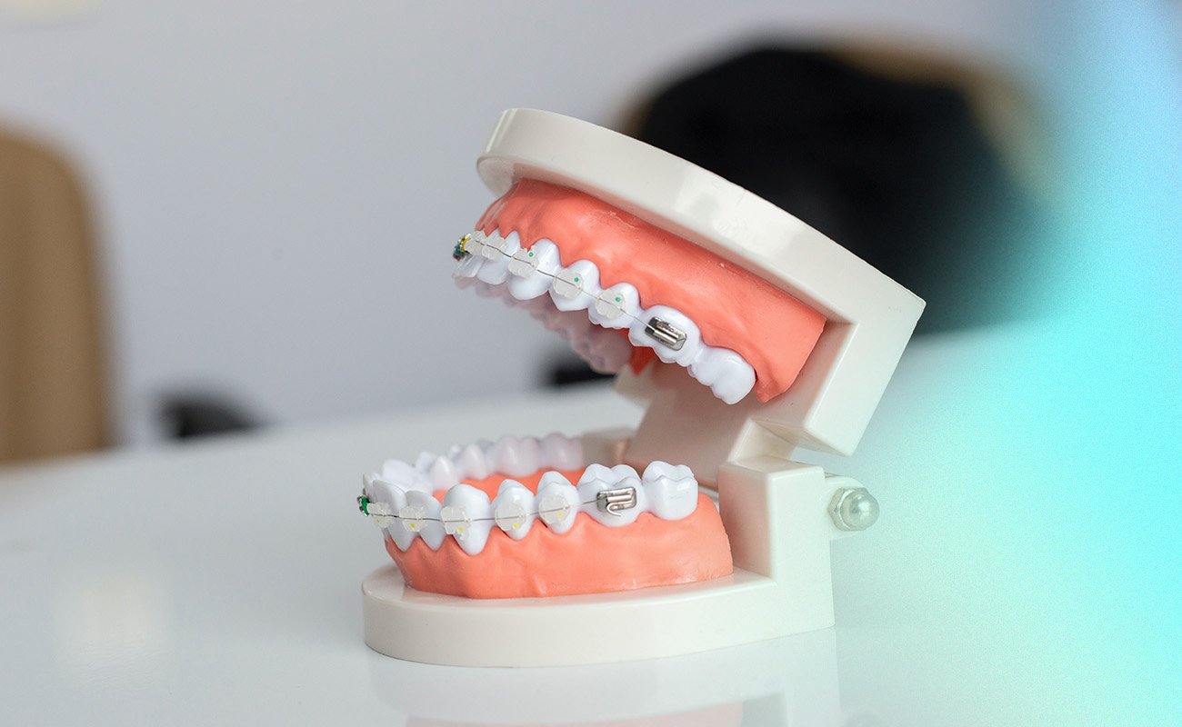 Types Of Invisible Braces