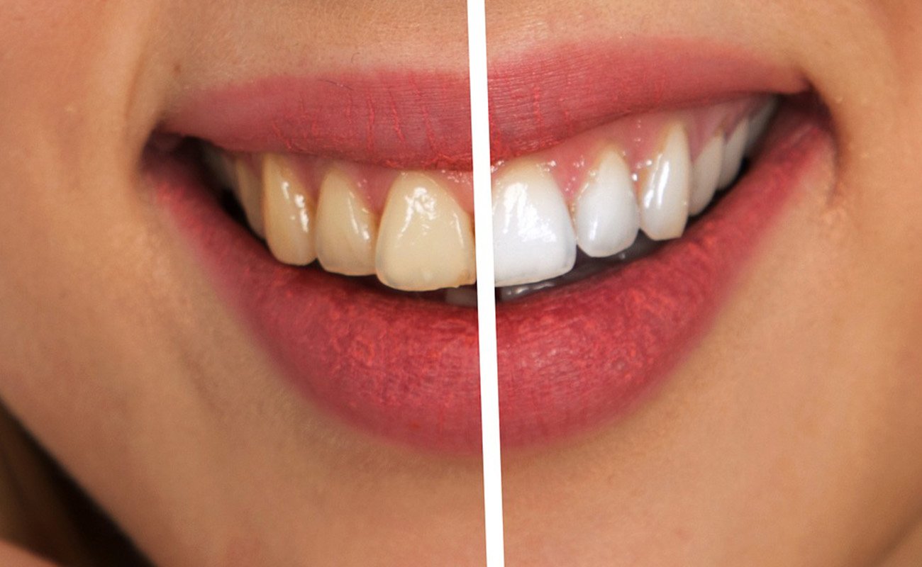 invisalign yellow teeth