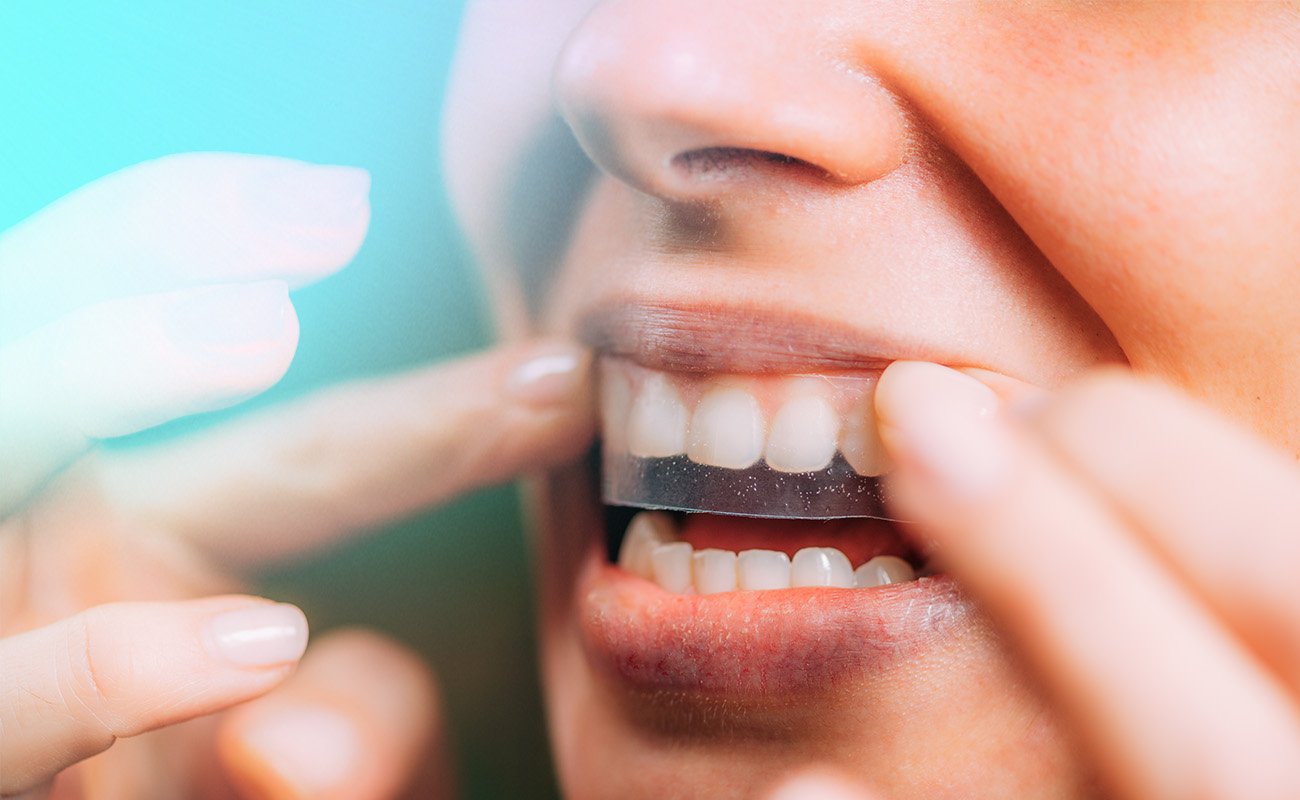 Can I Use Whitening Strips with Braces_ Facts and Myths about Teeth Whitening with Braces