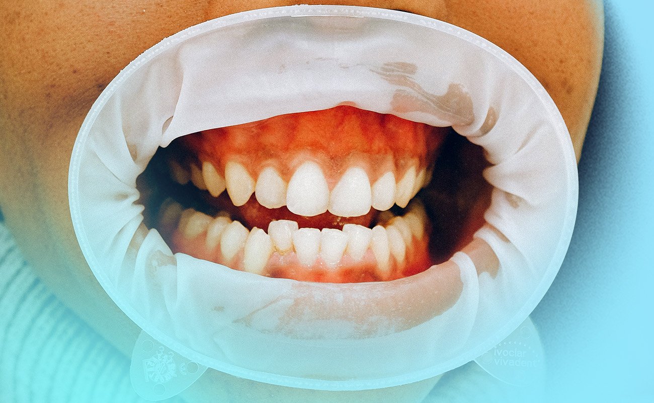 Do Aligners Cause Gum Recession