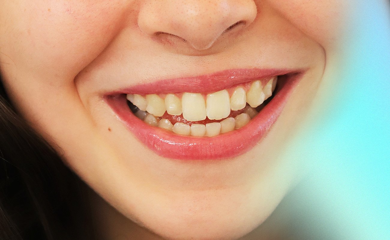 overjet braces