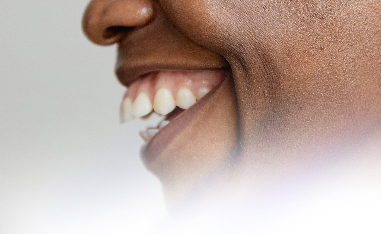 How to Fix Open Bite Naturally