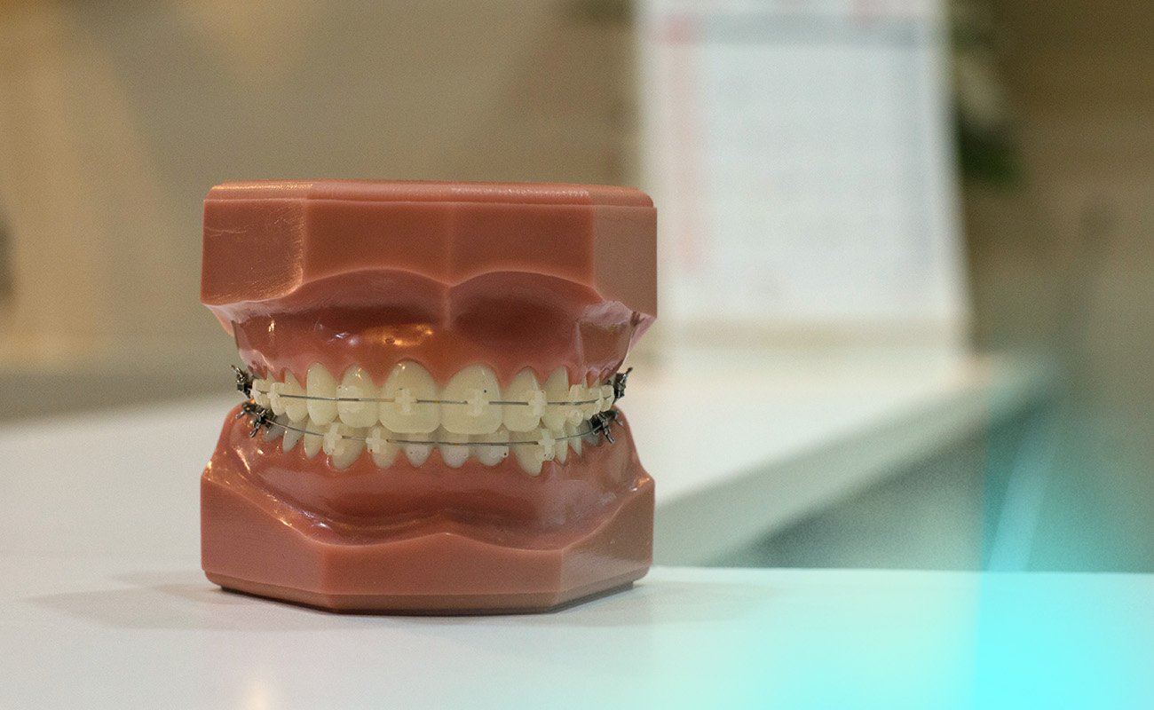 Can You Smoke Weed With Braces