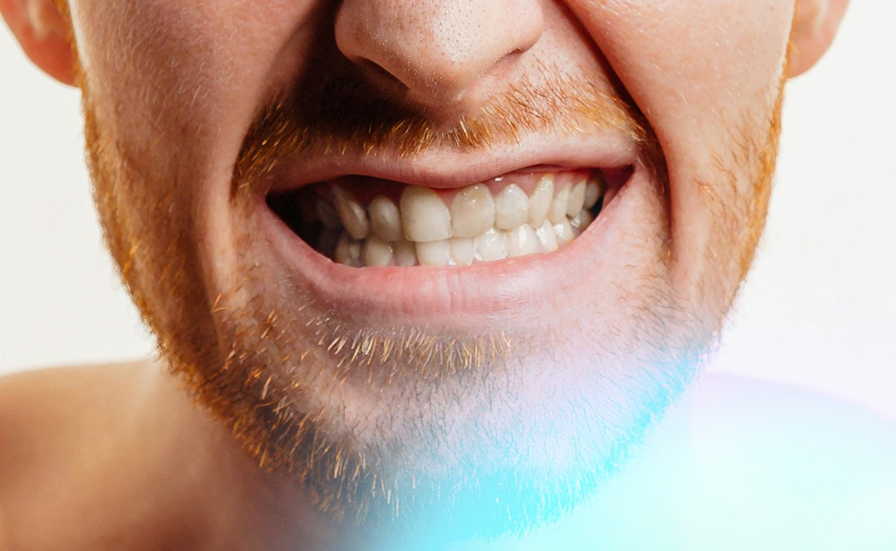 Teeth Crowding pain relief