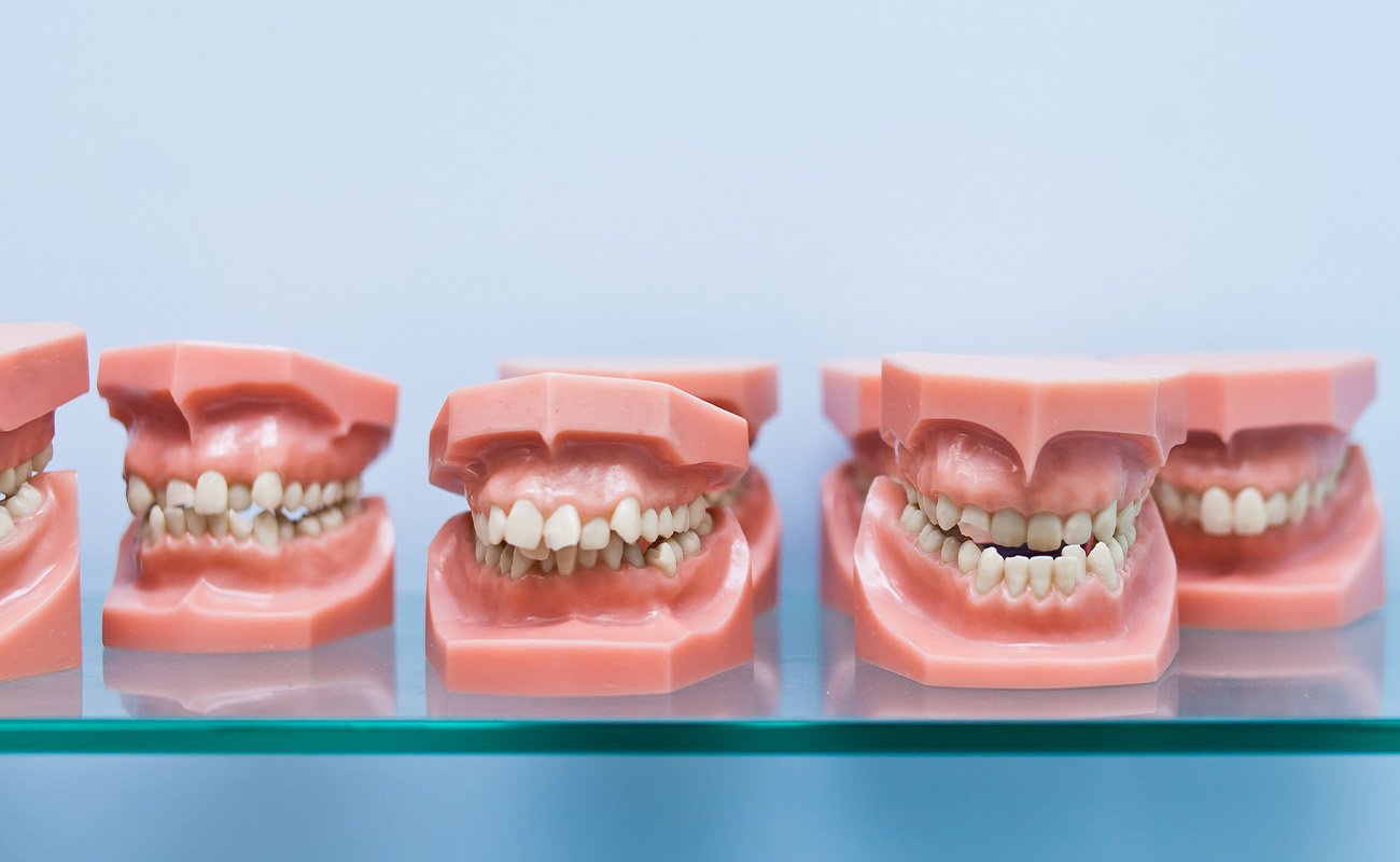 Types of Bites teeth