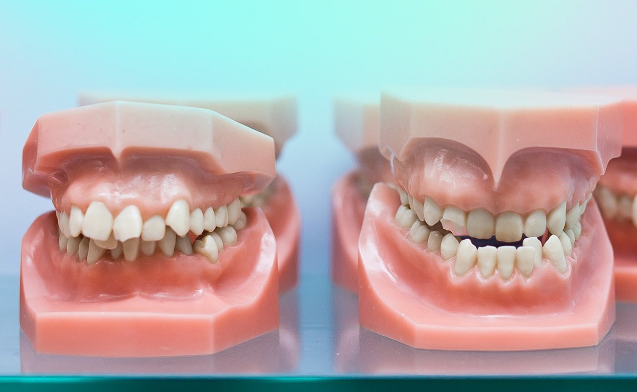 Underbite Vs Overbite