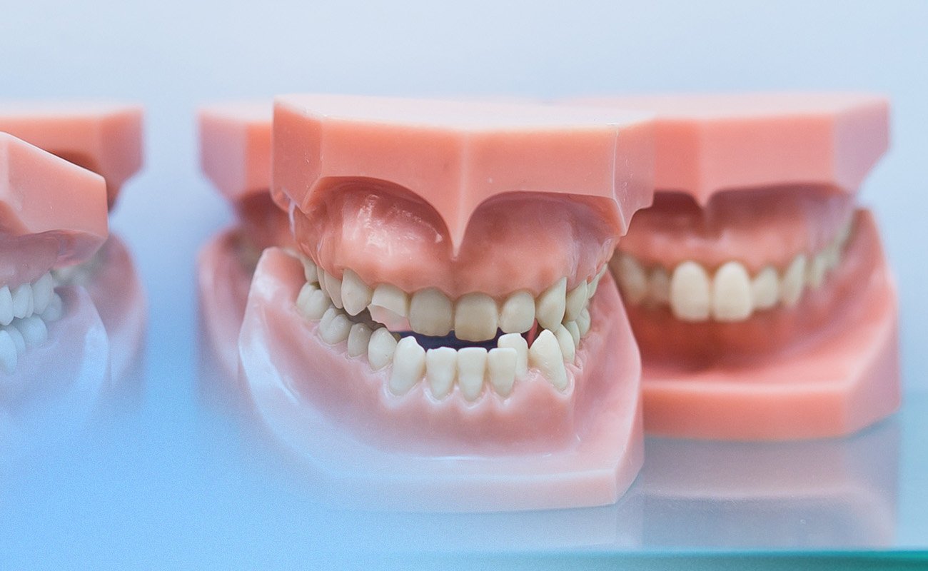 mild-underbite-causes-and-treatment-options