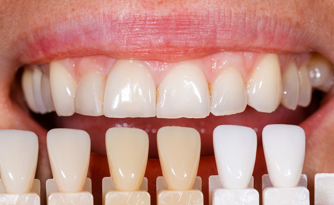 Why Are Veneers Expensive? Main Factors Behind the High Cost